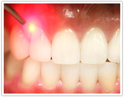 dental implants india